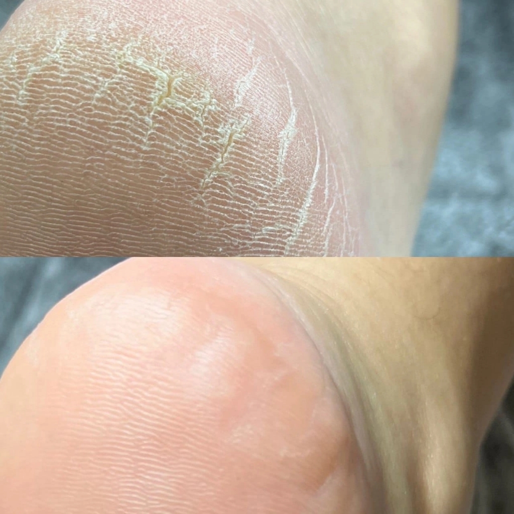 Педикюр гигиена