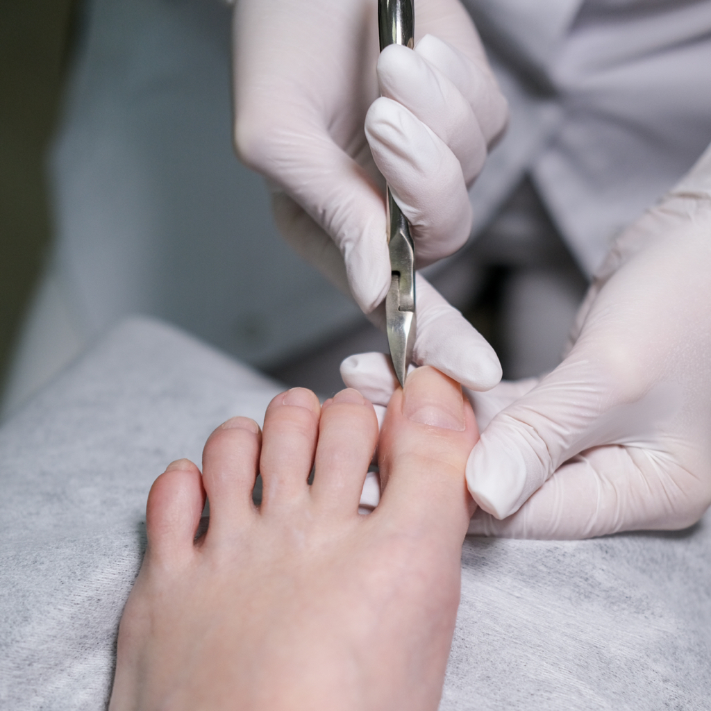 Коррекция вросшего ногтя