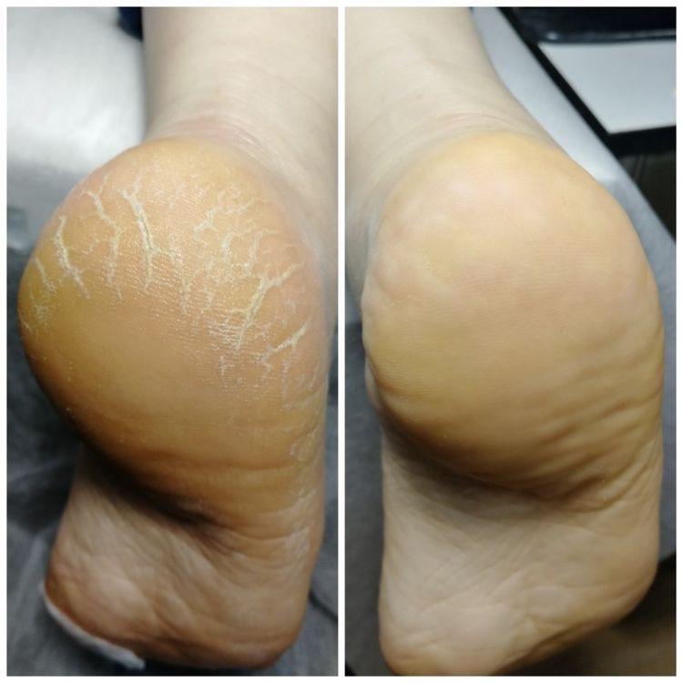 обработка стопы