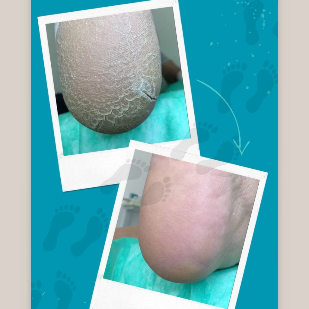 Обработка трещин