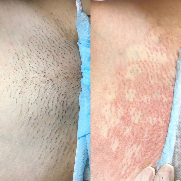 Глубокое бикини