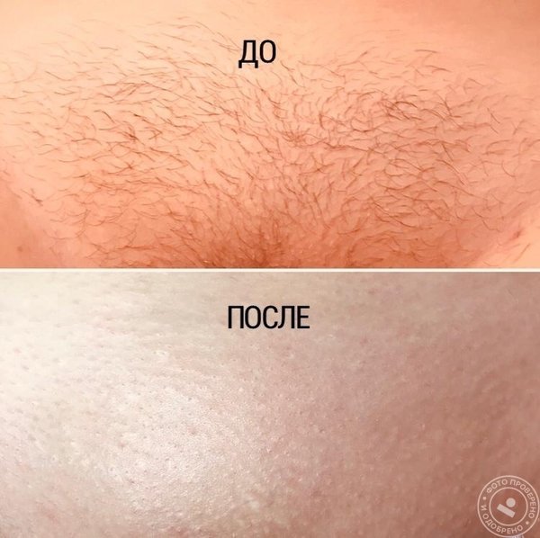 Глубокое бикини