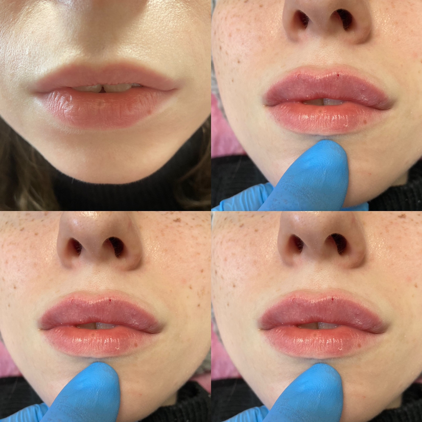 Увеличение губ