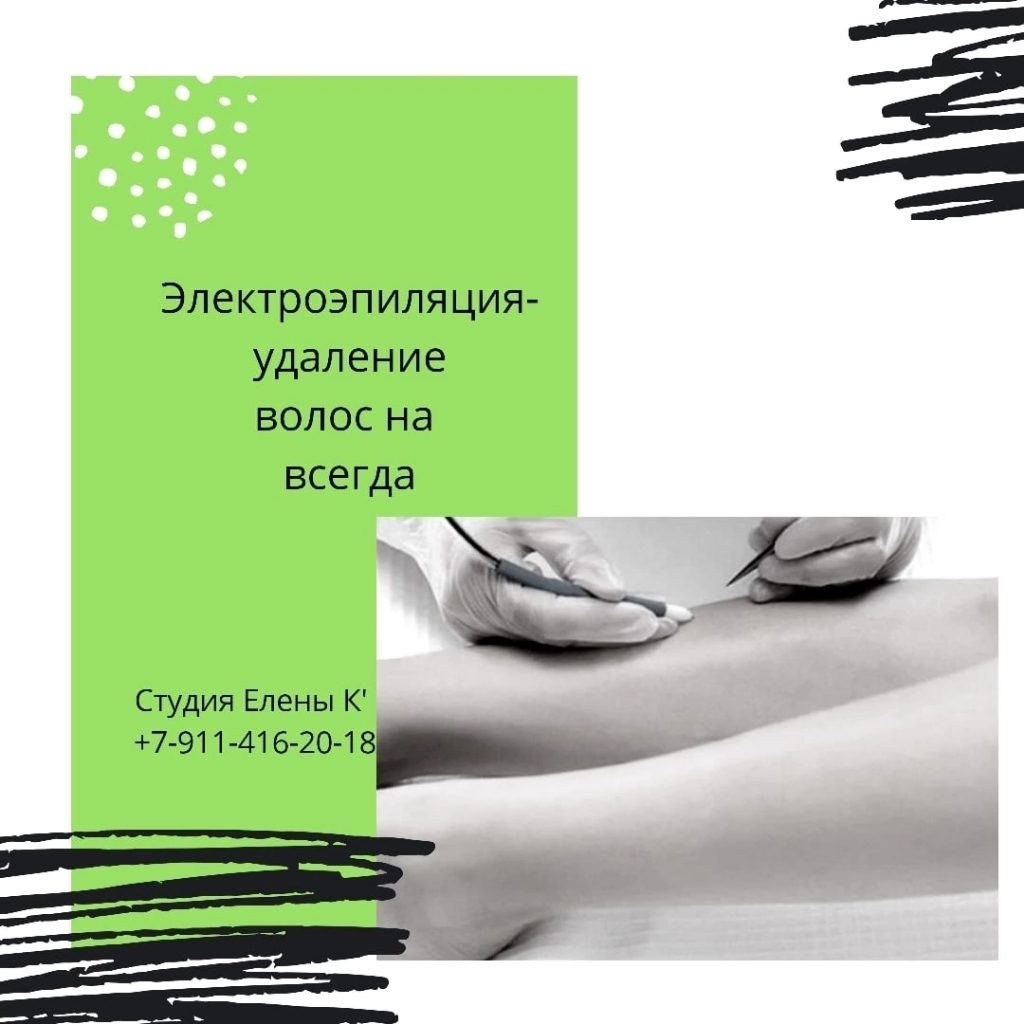 Электроэпиляция