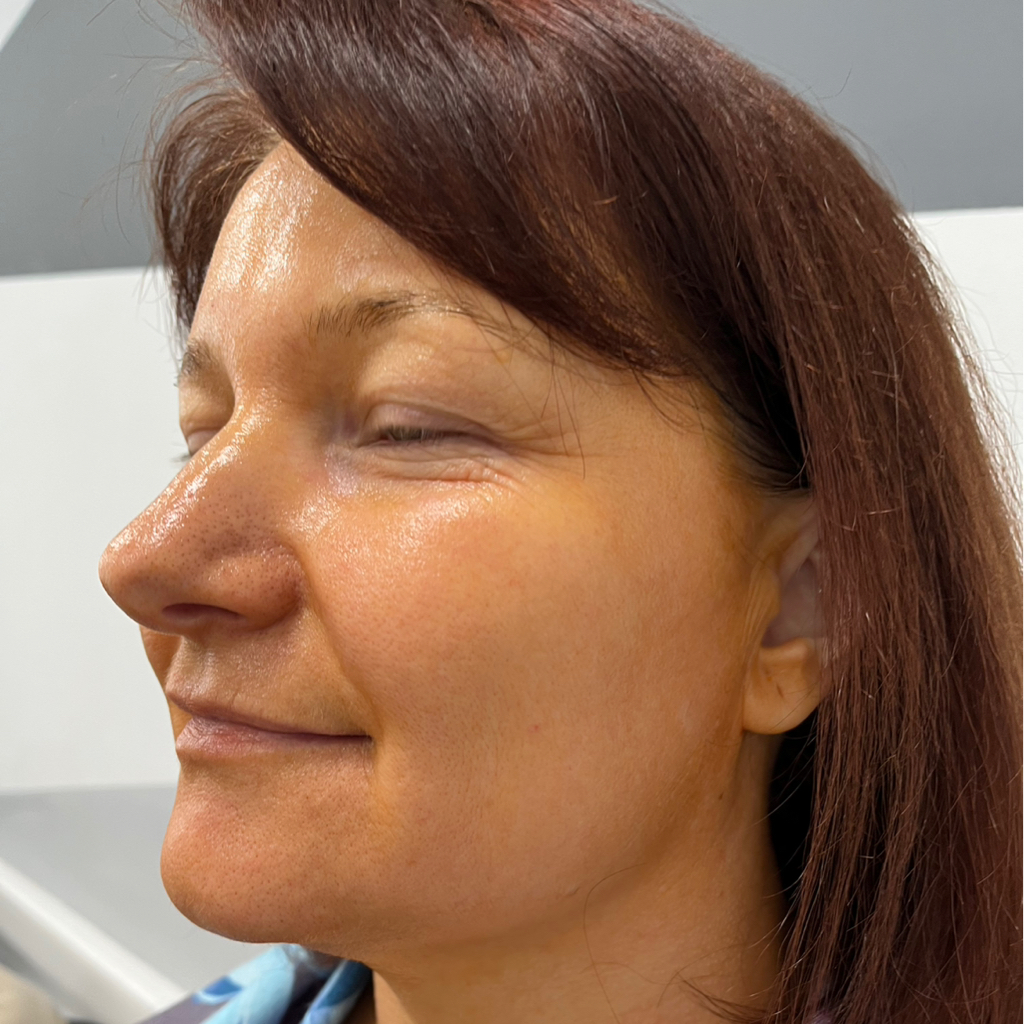 Пилинг желтый