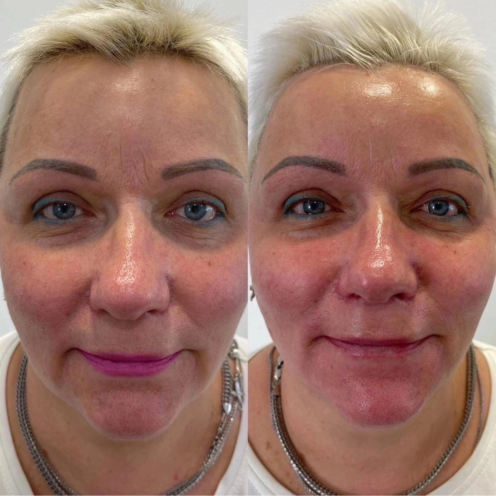 FlaxLift