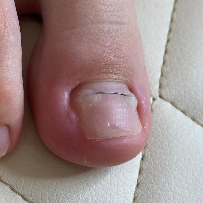 Коррекция вросшего ногтя  Титановая нить, приподнимает ногтевую пластину и предотвращает врастания ногтя.