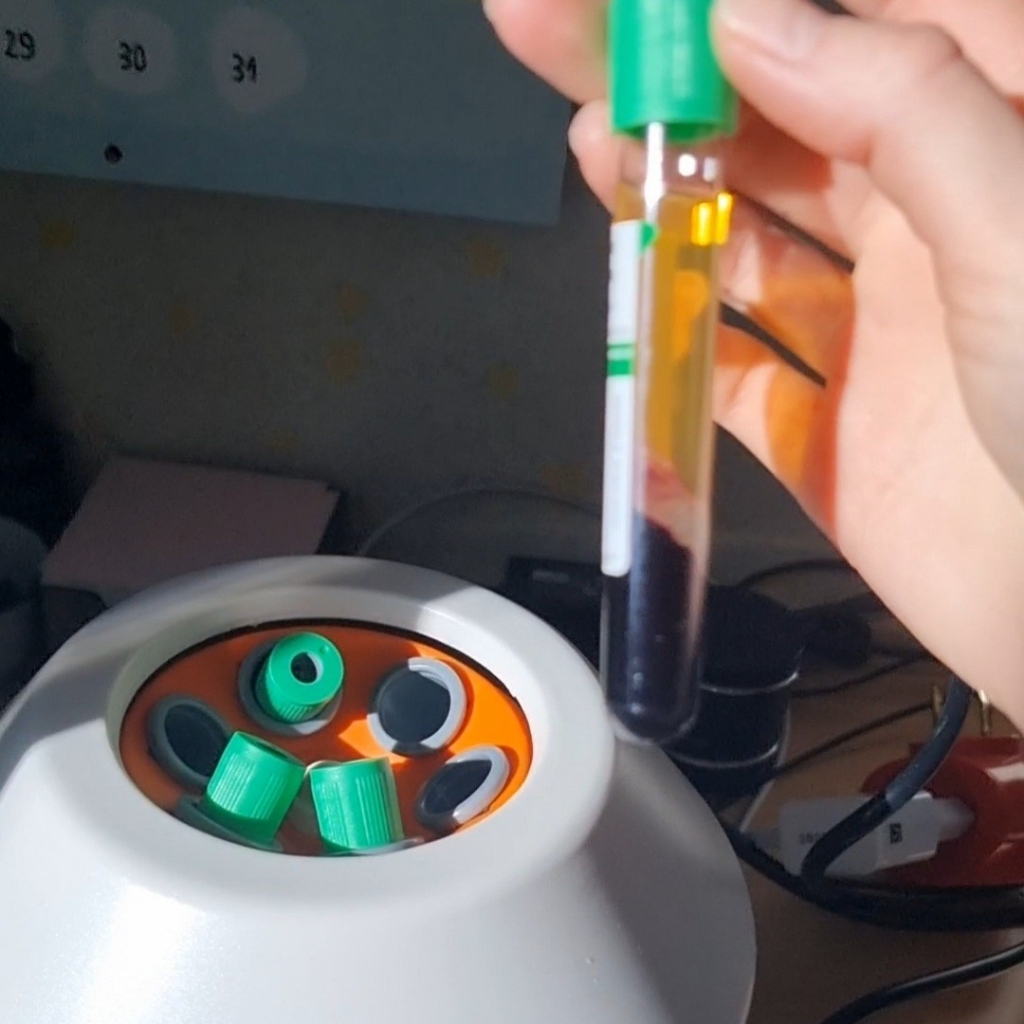 PRP волос цитратом натрия 2пробирки