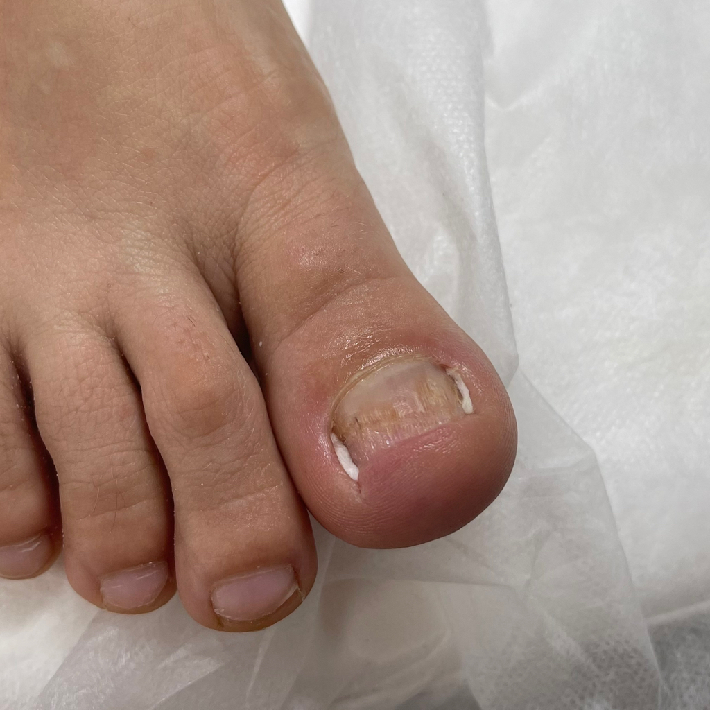 Тампонирование 1 ед