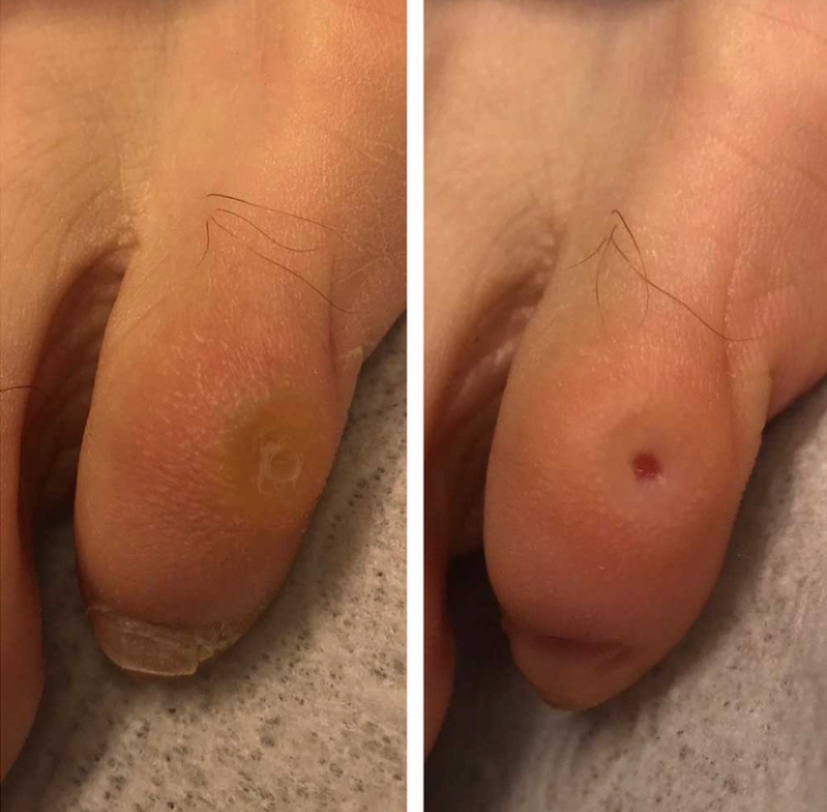 Удаление стержневой мозоли / натопавшая 1 ед.