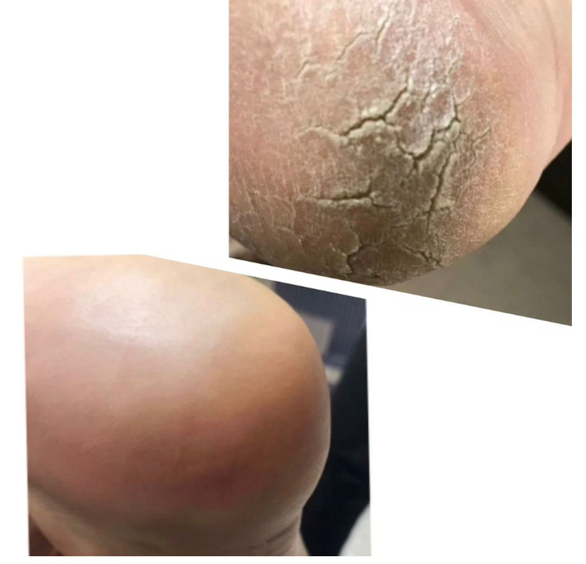 Обработка трещин на пятке