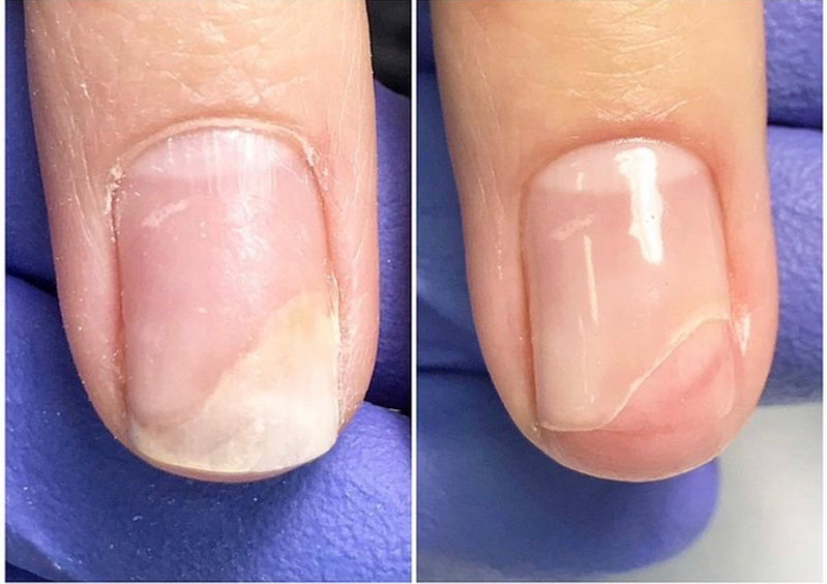 Зачистка 1 ногтевой пластины на руках при онихолизисе