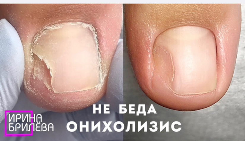 Зачистка 1 ногтевой пластины на ногах при онихолизисе от 200 до 500₽ (от сложности)