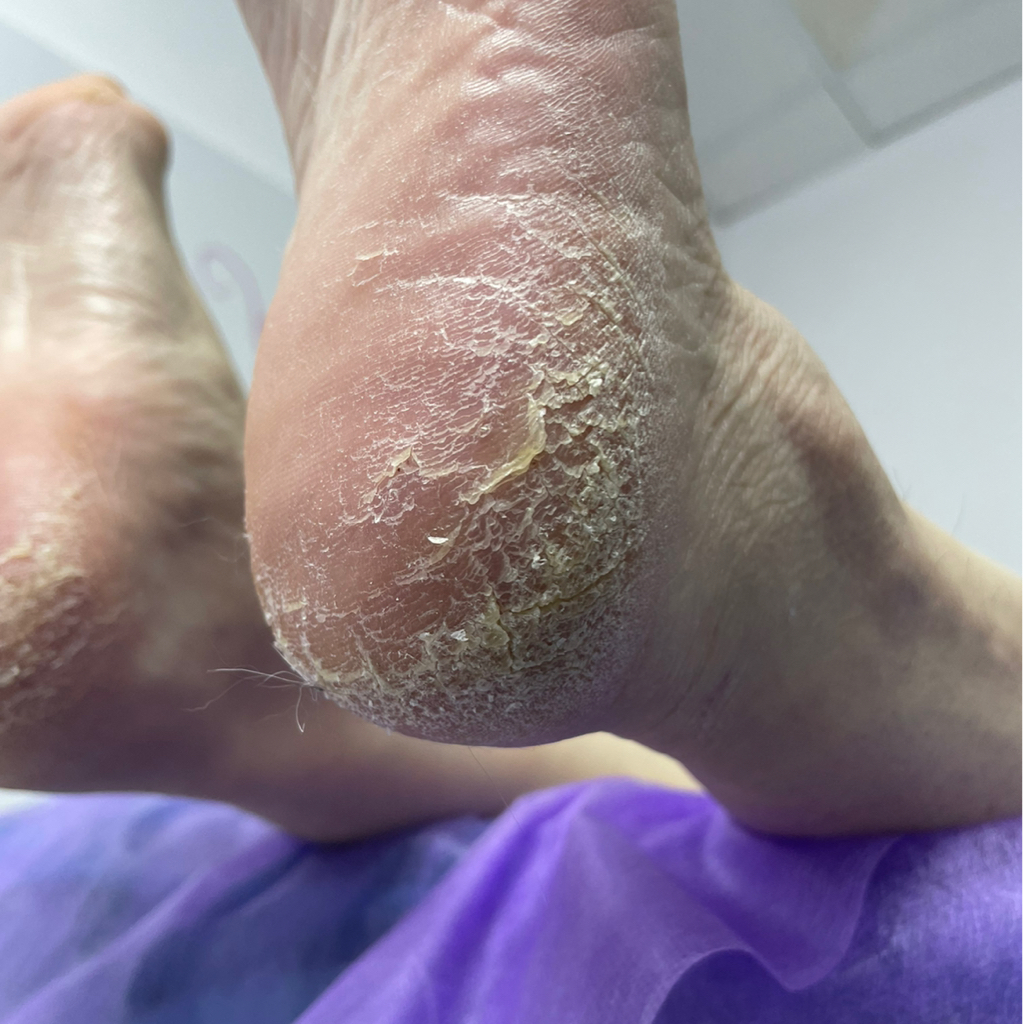 Сложные стопы;