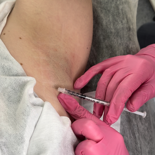 Лечение гипергидроза подмышек