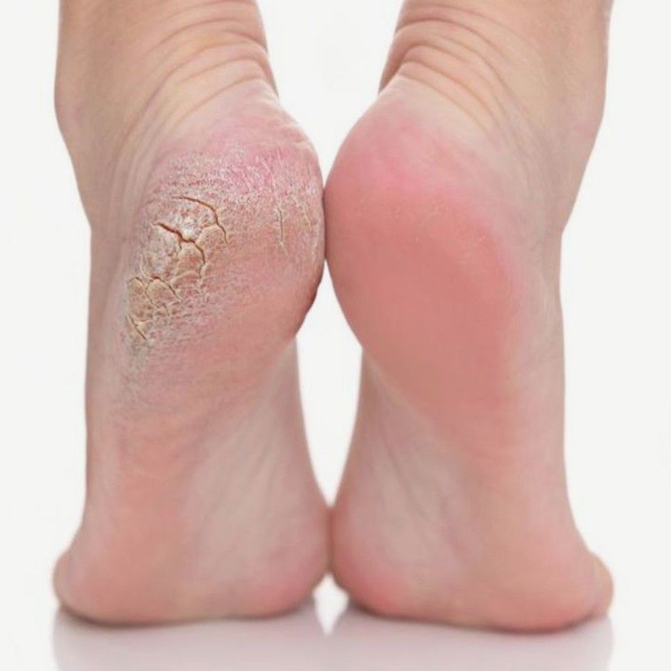 Педикюр (обработка стопы)