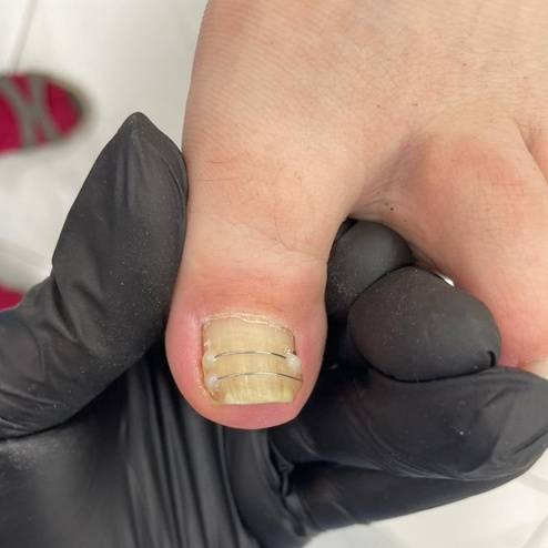 Титановая нить