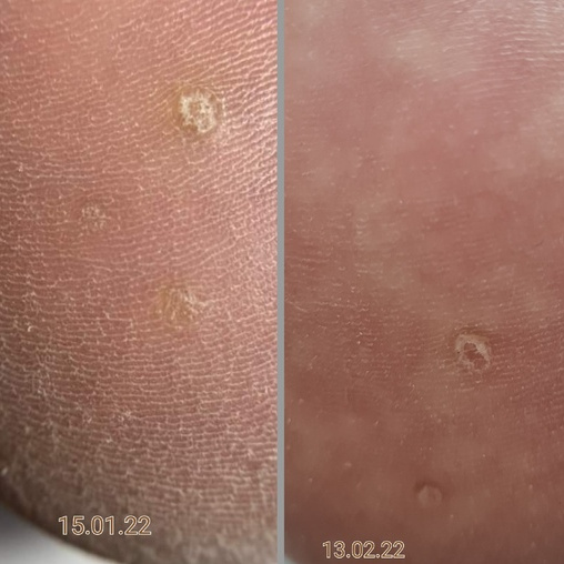 Обработка бородавки