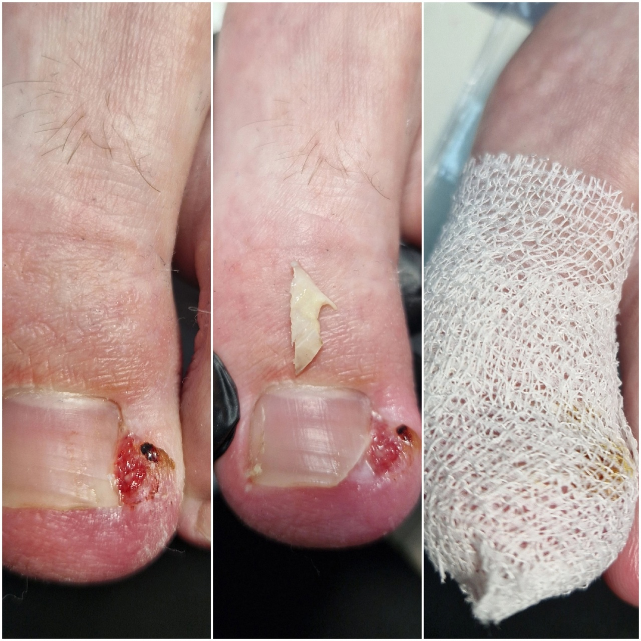 Обработка вросшего ногтя