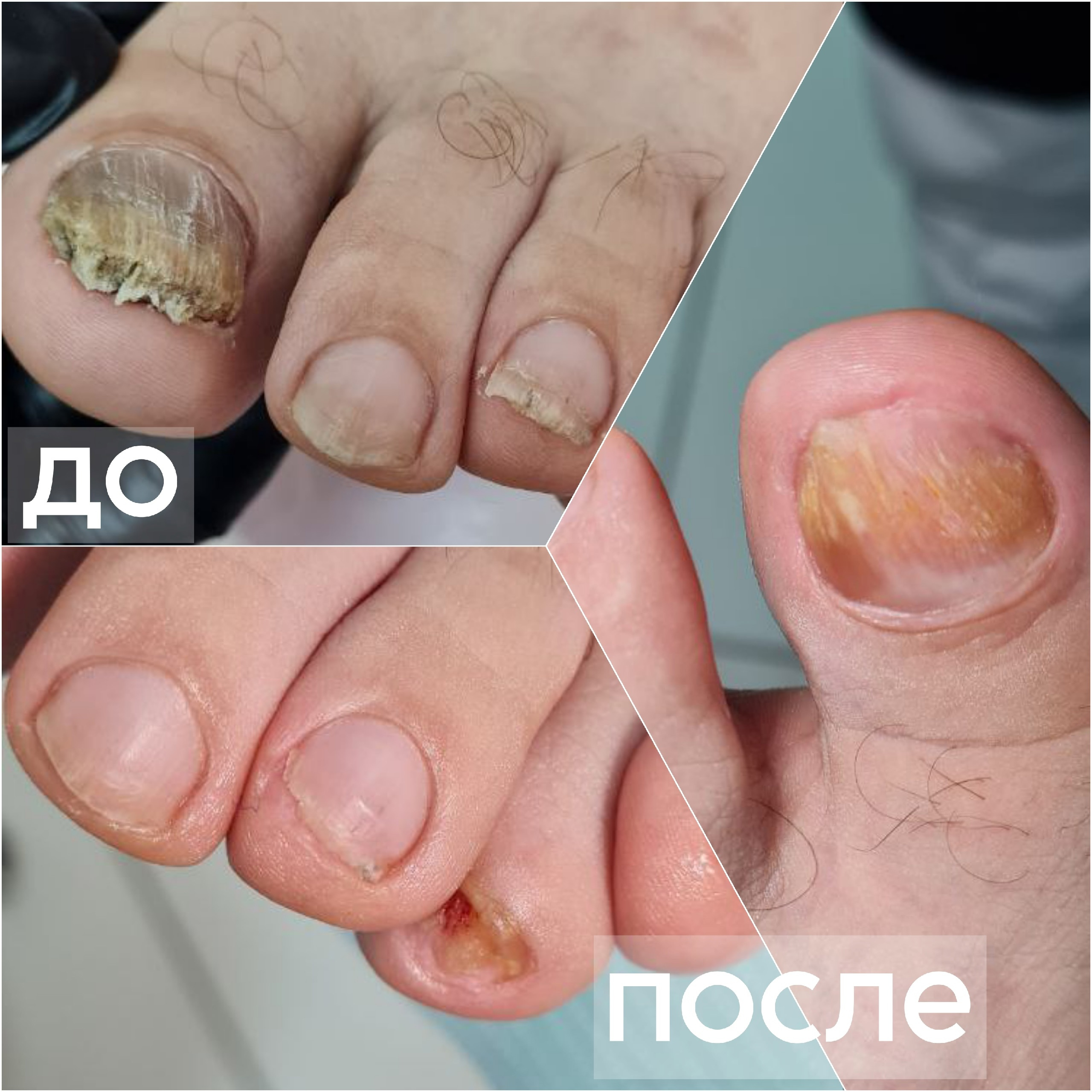 Подологический педикюр