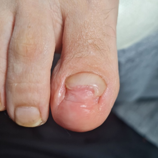 Обработка ногтей (грибковые поражения, травма)