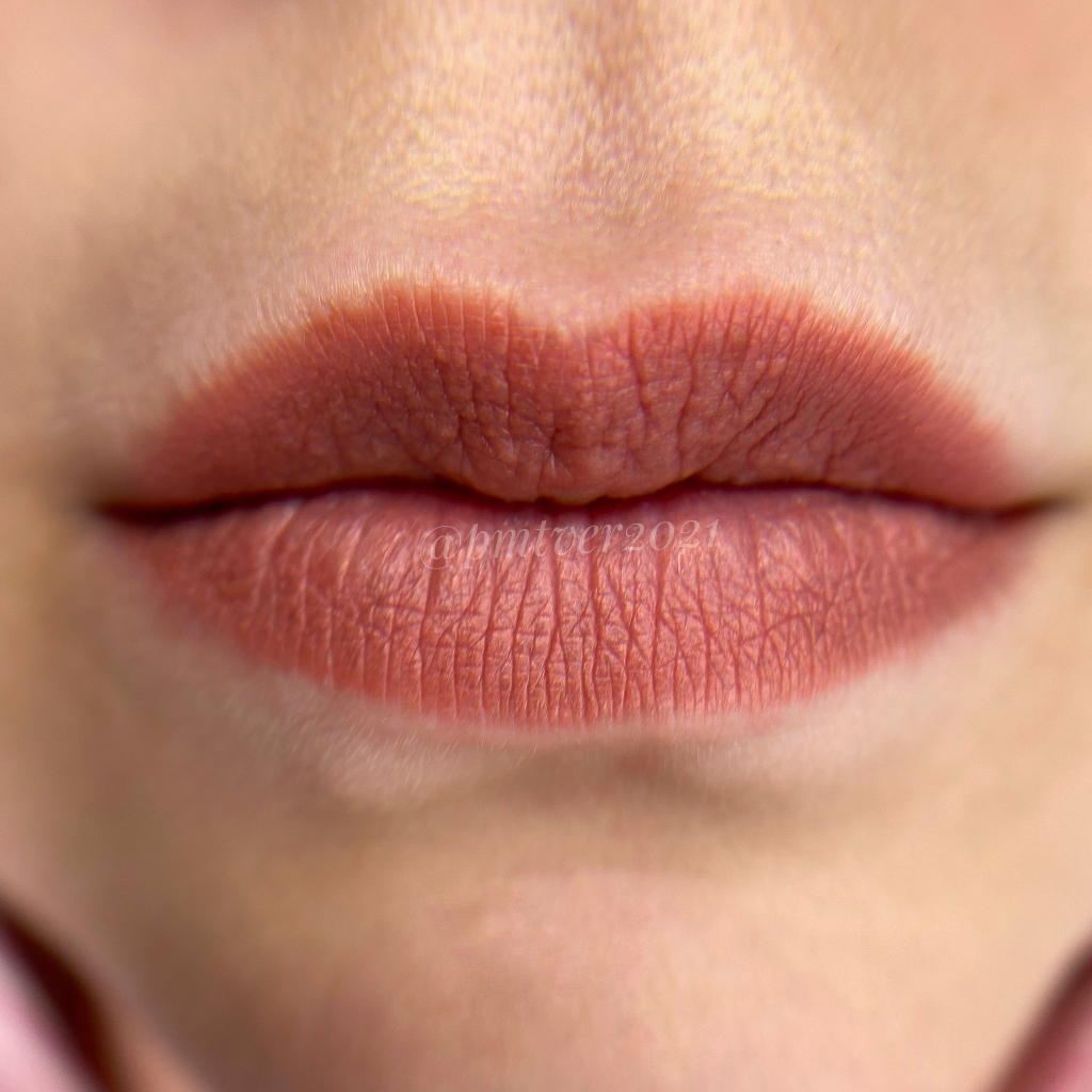 Коррекция губ через 1-2 месяца после 1 процедуры