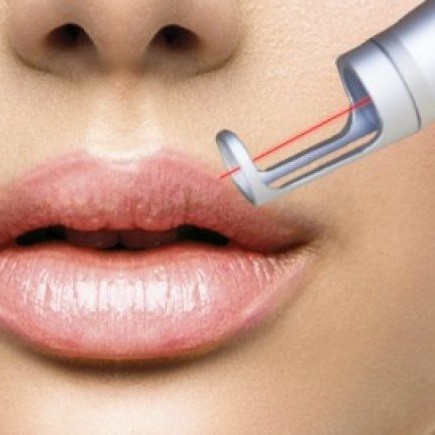 Удаление ПМ губ