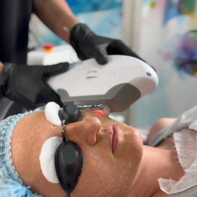 Коррекция пигментных пятен и веснушек