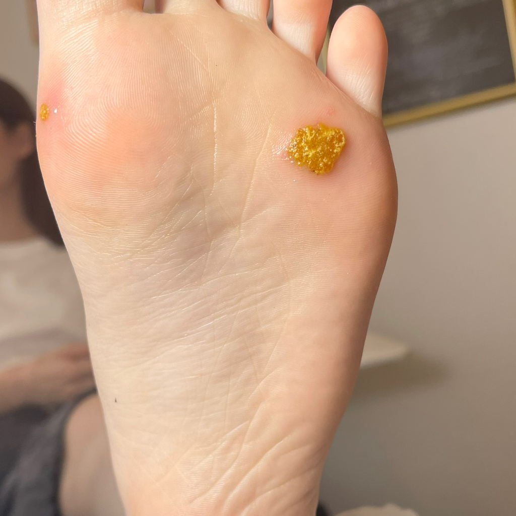 Обработка бородавок