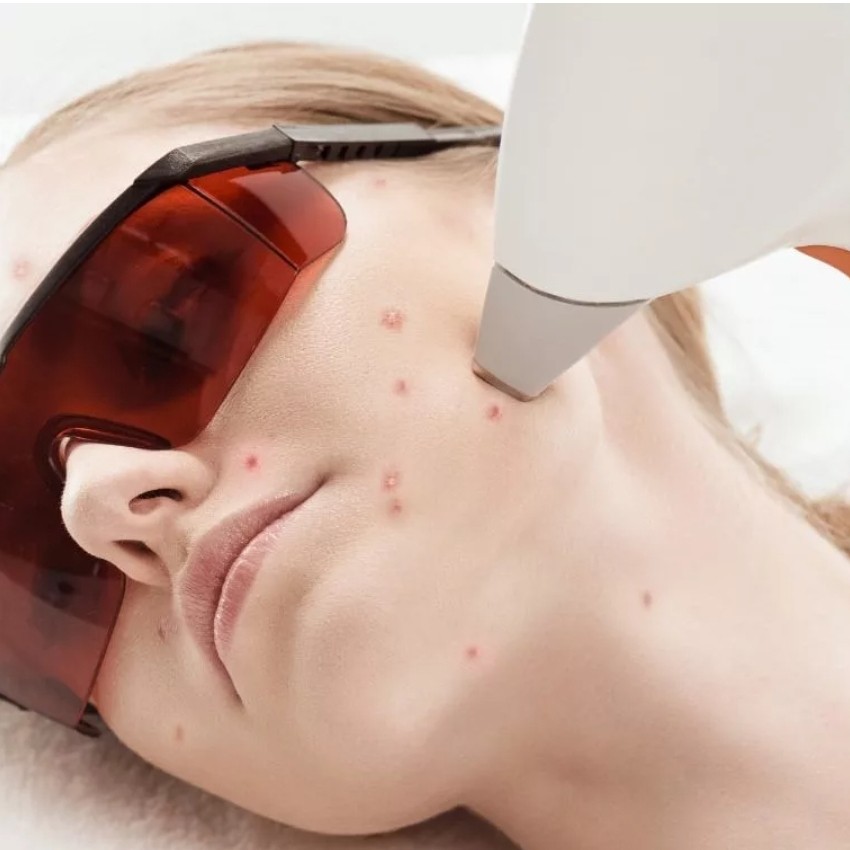 Коррекция акне/постакне