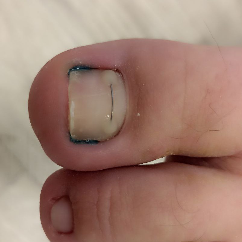 Коррекционные системы (титановая нить,  light system, ЗТО)