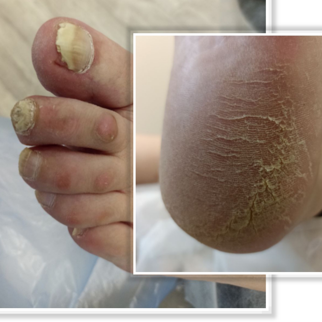 Педикюр. Подология