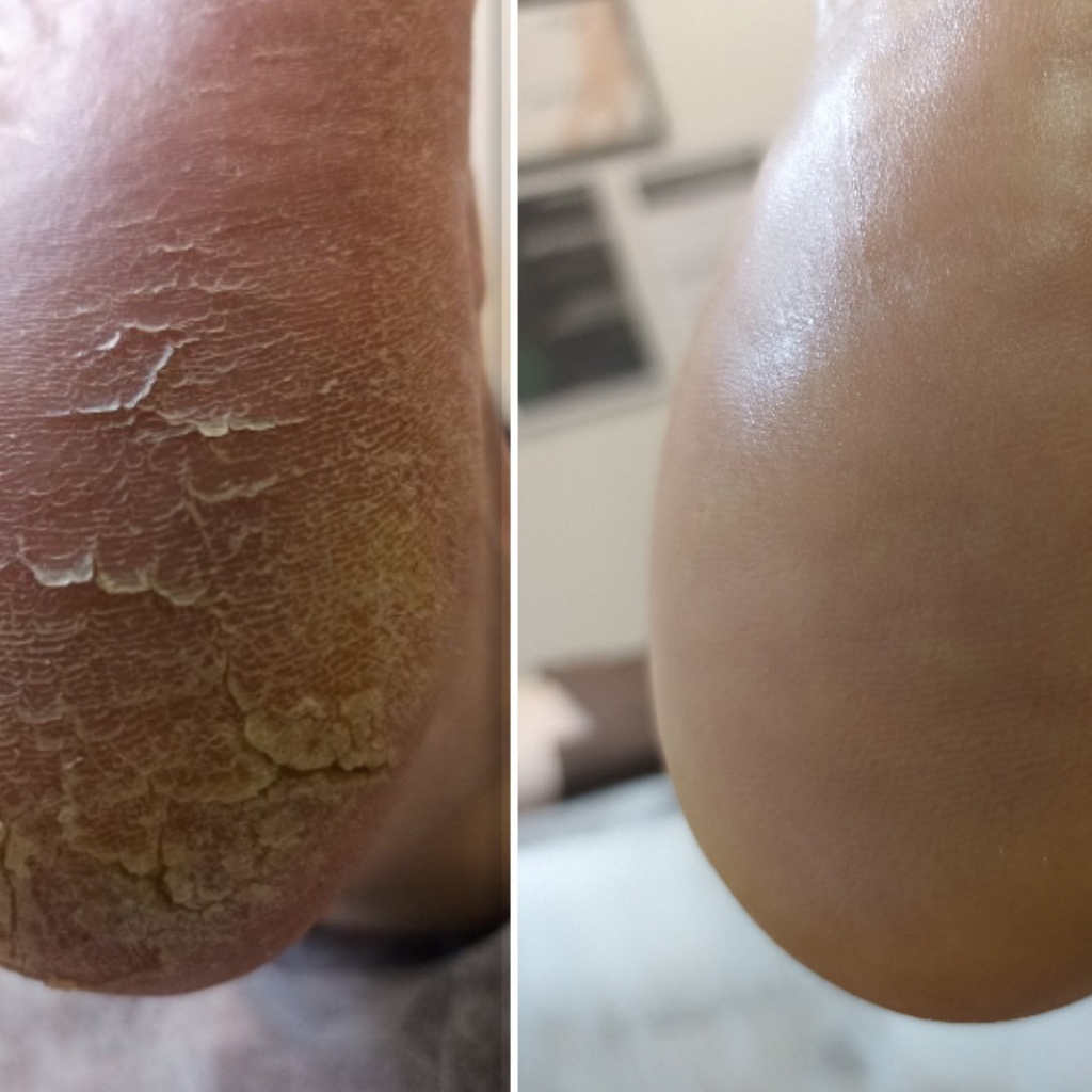 Здоровая стопа