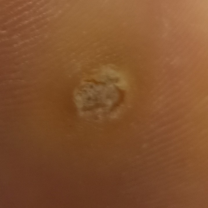 Удаление бородавки