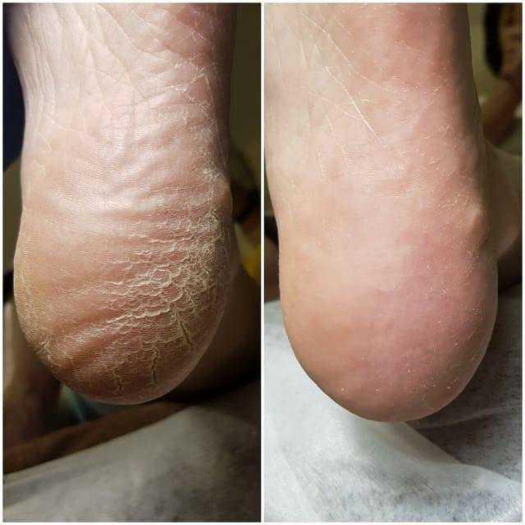 Обработка кожи стоп