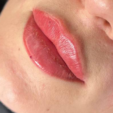 Увеличение губ