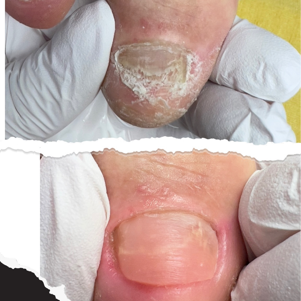 Протезирование 1 ноготь