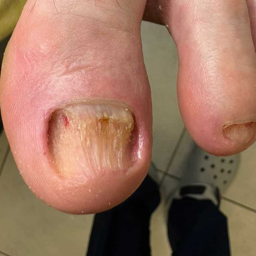 Зачистка онихомиказа (1 палец)