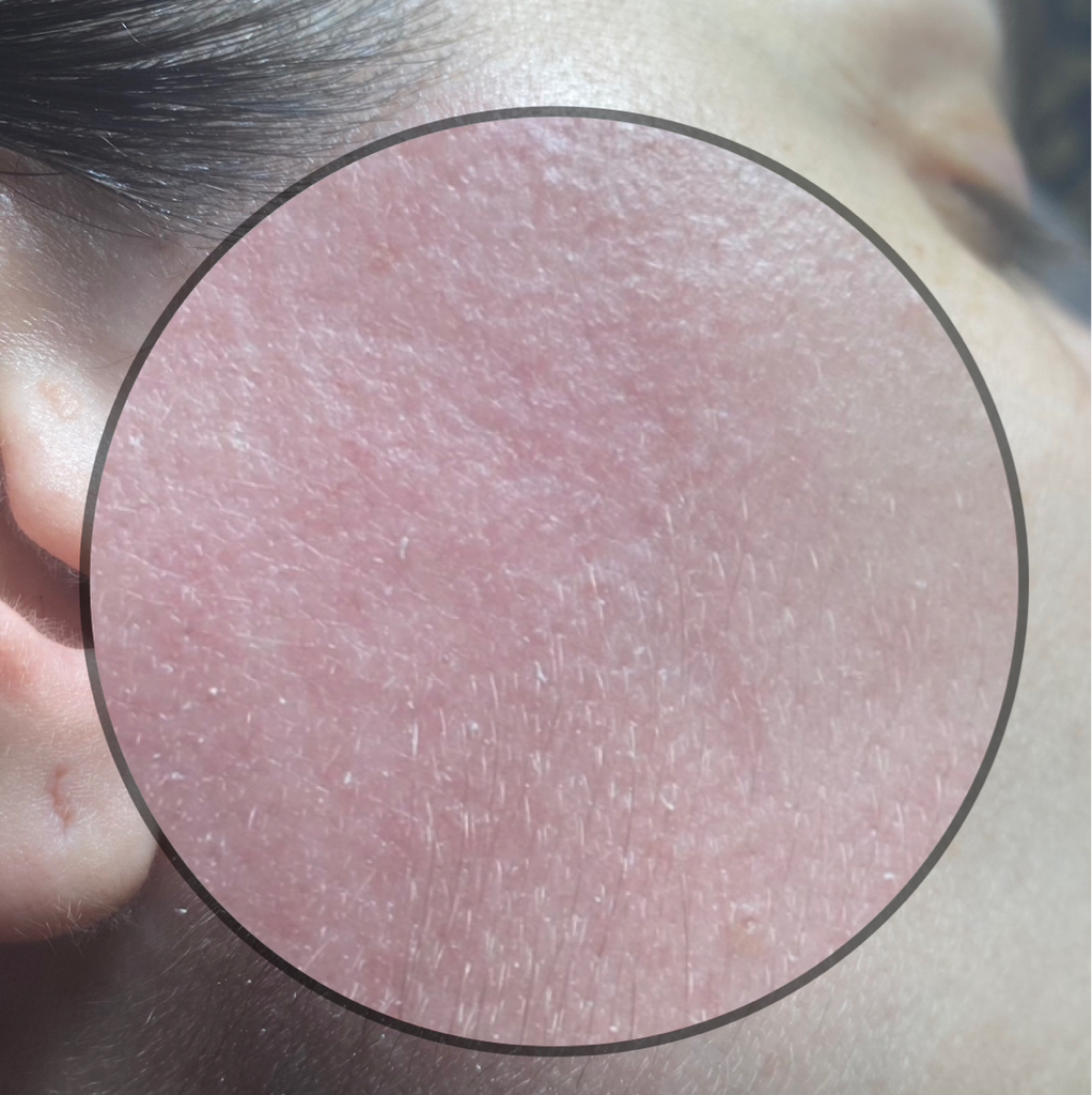 Электроэпиляция /лицо/