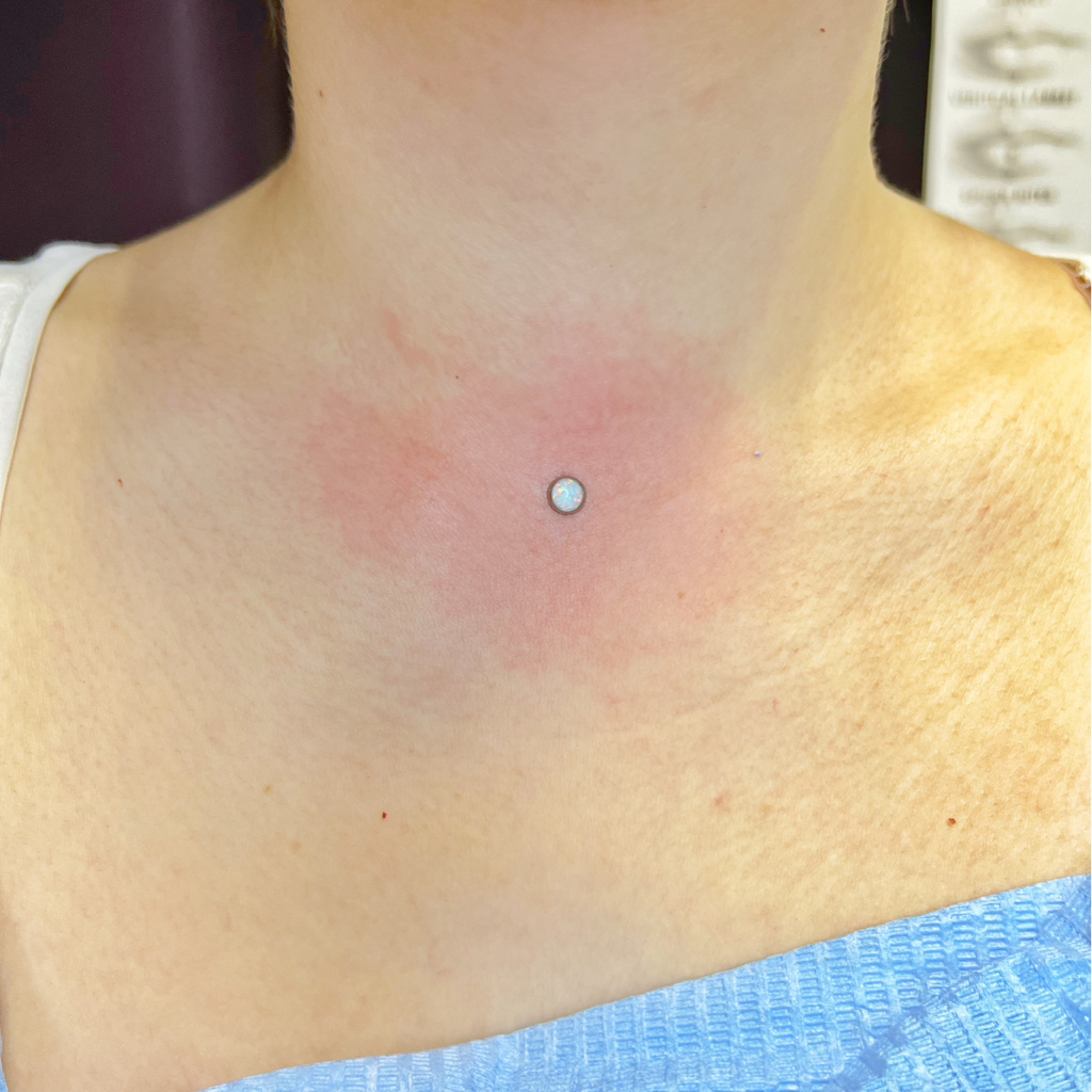 Микродермал