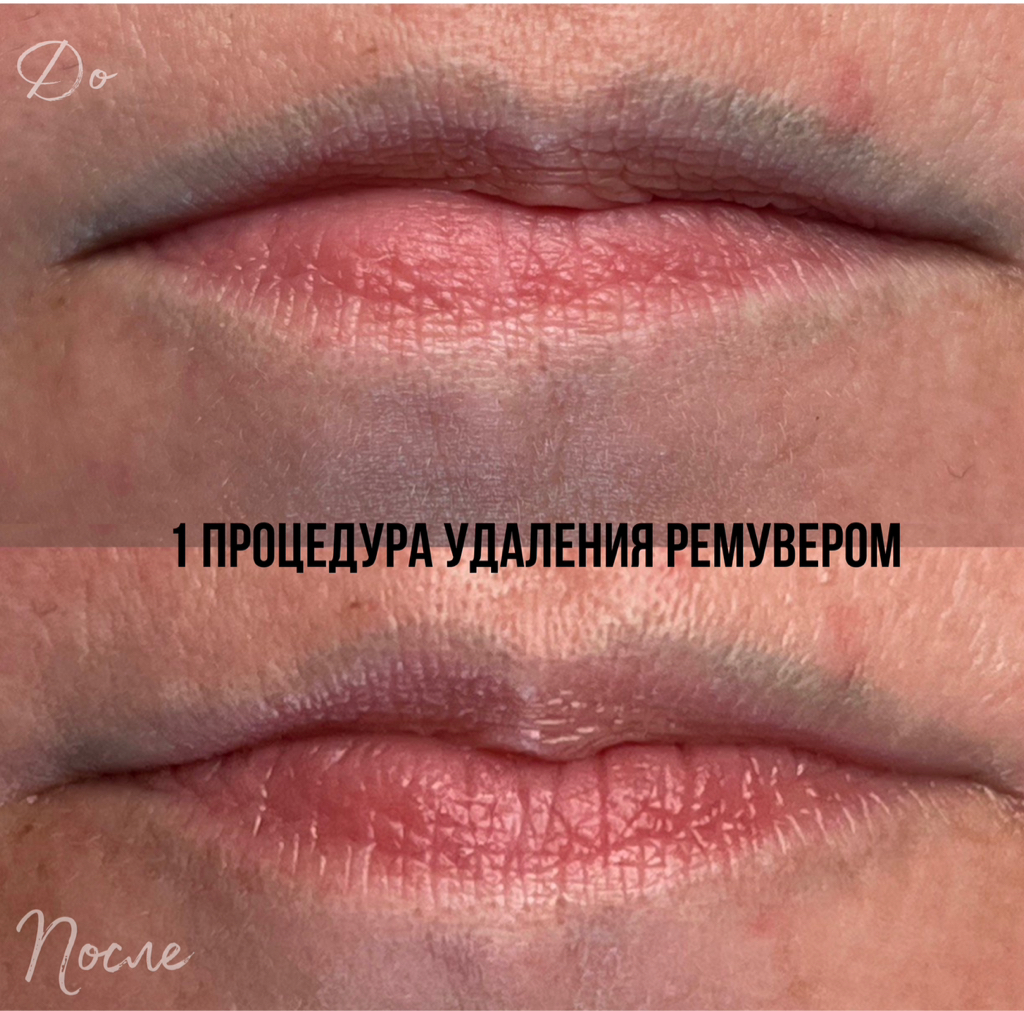 Удаление ремувером 1 сеанс
