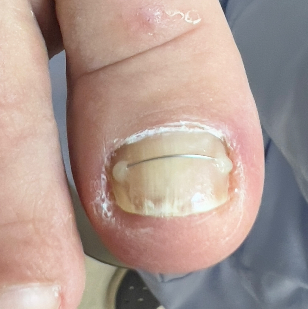 Титановая  нить за 1 палец + консультация