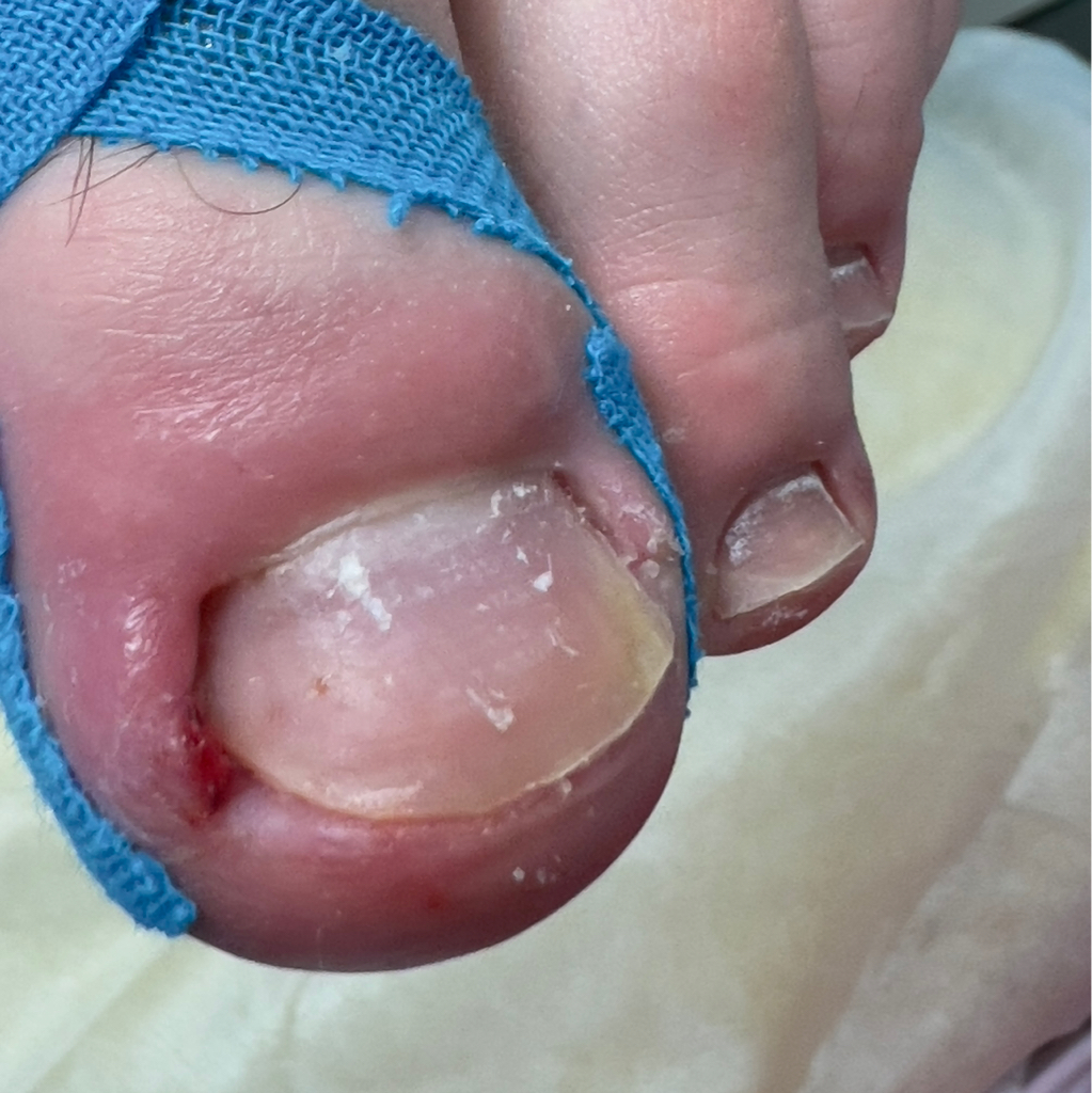 Вросший ноготь III стадии + консультация (1 палец )