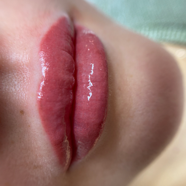 Коррекция ПМ губы