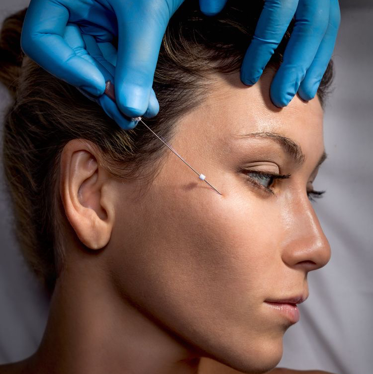 Векторный лифтинг полимолочной кислотой ( PLLA) Препарат Elastifill