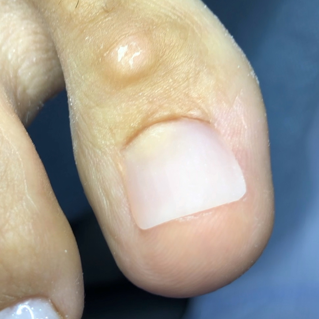 Протезирование ногтей