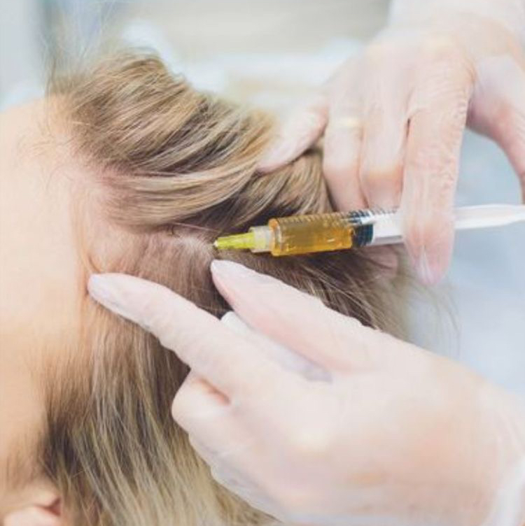 Мезотерапия волосистой части головы  Препарат hair-x с pdrn