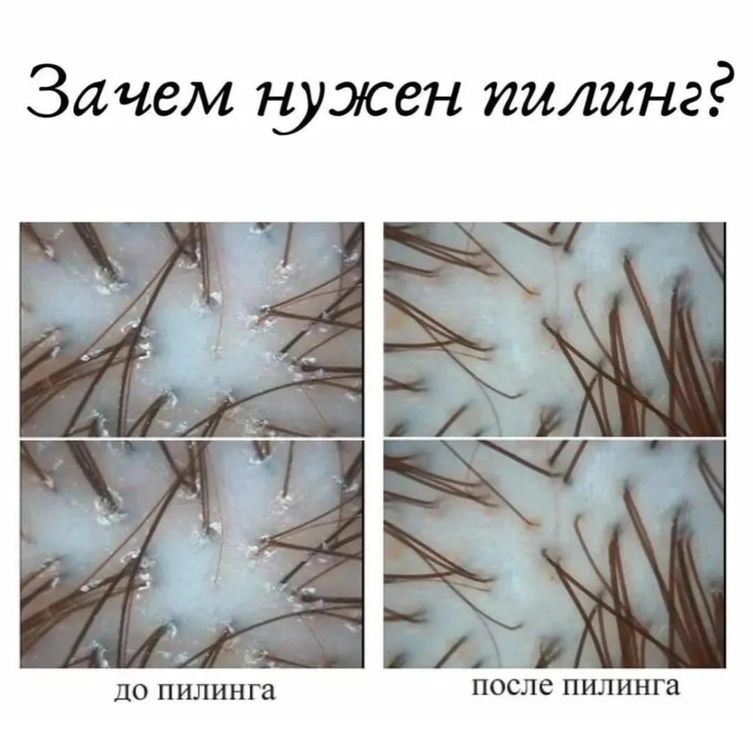 Пилинг кожи головы и детоксикация волос