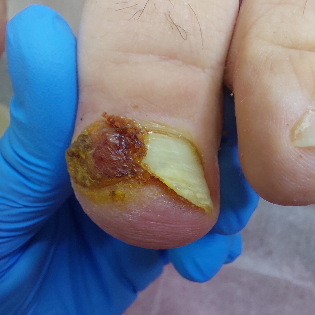 Прием с острой болью