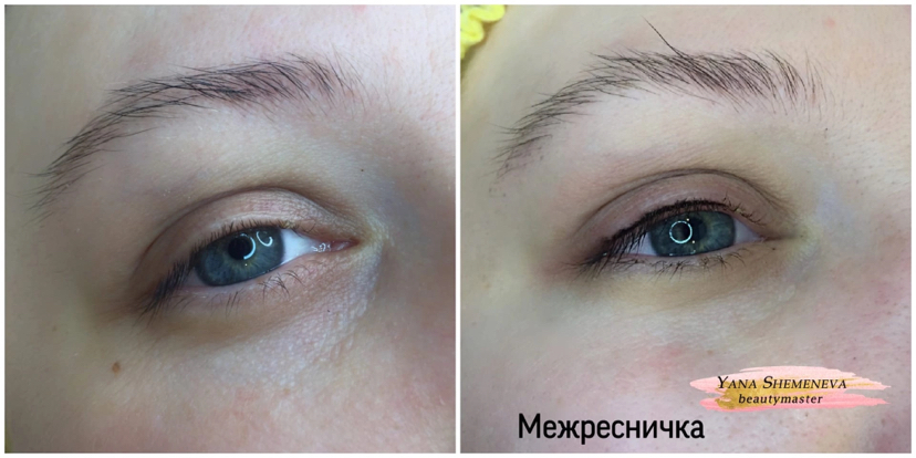 Межресничка